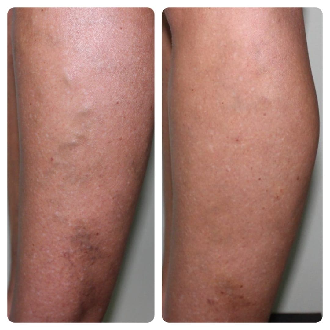 Resultado antes e depois de tratamento vascular - caso 1