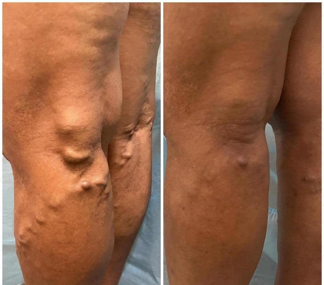Resultado antes e depois de tratamento vascular - caso 3