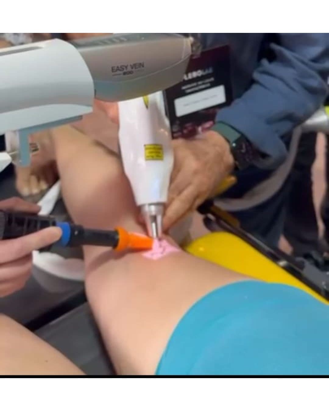 Dr. José Carlos realizando procedimento com laser ND:YAG 1064