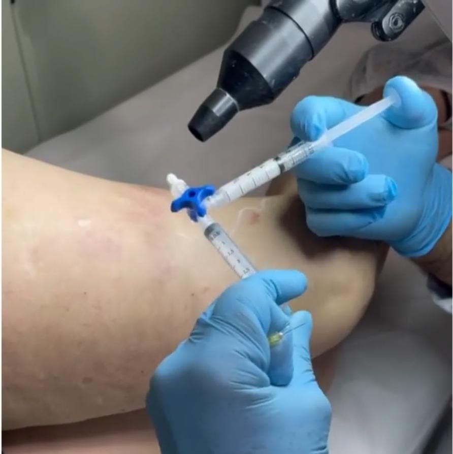 Escleroterapia com Espuma