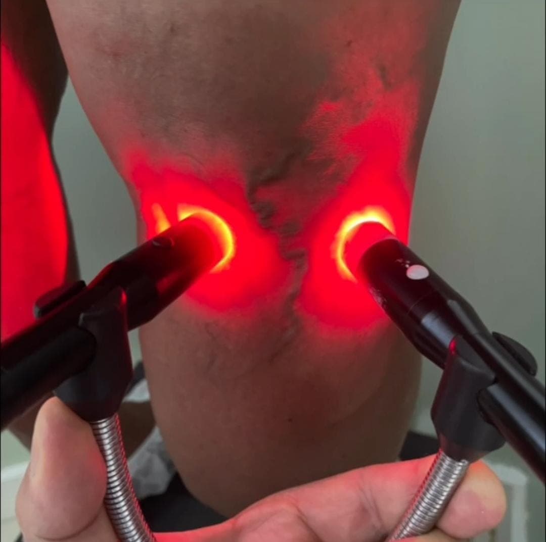 Dr. José Carlos identificando veia antes de realizar macroescleroterapia com espuma